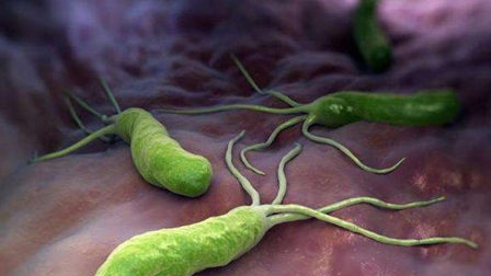 幽门螺杆菌需要根除吗 如何避免被感染