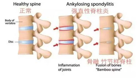 关注强直性脊柱炎：“竹竿病”到底有多凶险？