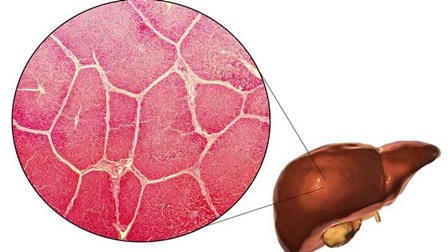 科学认识警惕慢性肝病“三部曲”